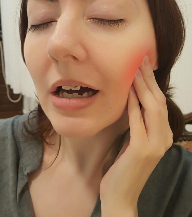 חריקת שיניים, נעילת לסת וכאבי פנים(TMJ,TMD) - רפואה סינית - דיקור סיני